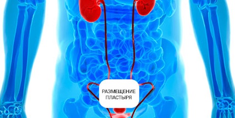 Чоловічий урологічний трансдермальний пластир від простатиту і імпотенції