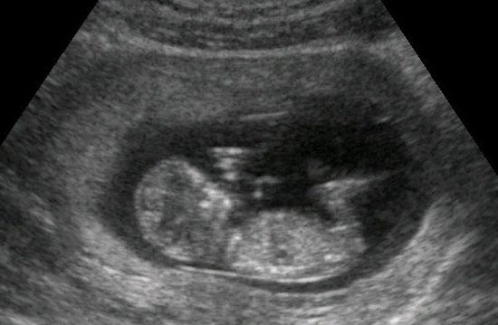Ктр 10 недель. Ребенок ге 12 недель как выглядит.