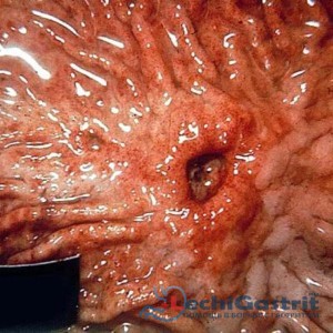 Симптоми гастриту і виразки шлунка, ознаки патологій