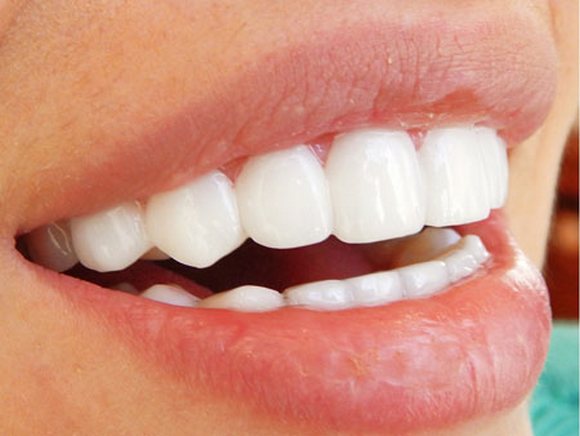Що таке вініри в стоматології і яка ціна на один зуб