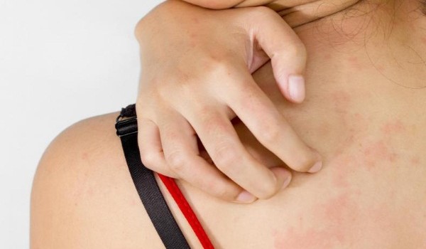 Прищі на спині у жінок: причини та ефективне лікування