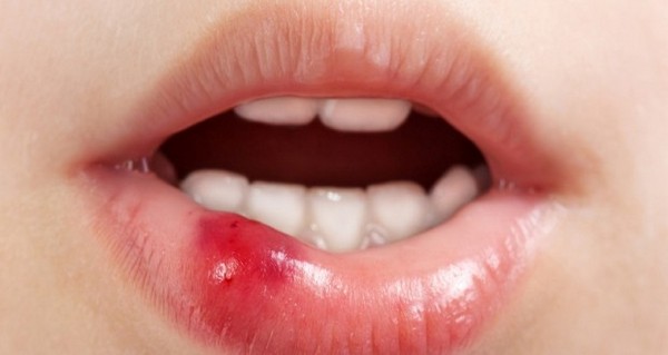 Гіалуронова кислота для збільшення губ: дія, опис процедури, можливі наслідки та рекомендації