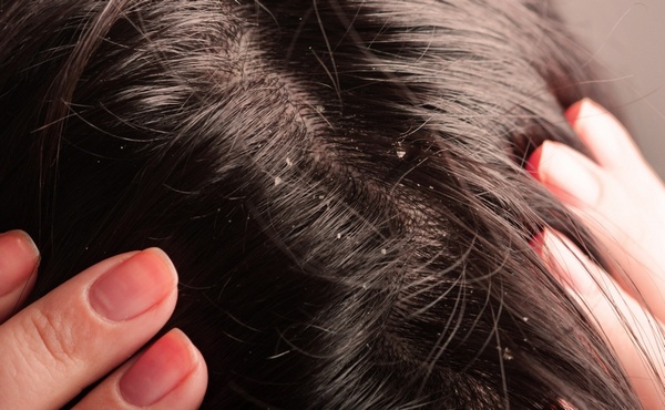 Прояв і ефективне лікування шкірної себореї голови