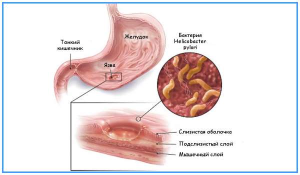 Ускладнення виразкової хвороби шлунка і дванадцятипалої кишки