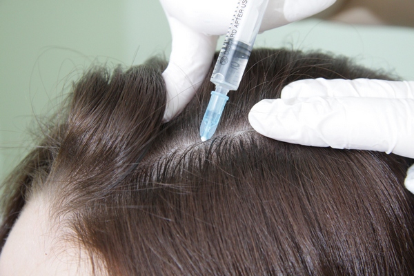 Мезотерапія для волосся: фото до і після, ціни та відгуки