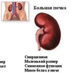 Гіпертонічна нефропатія: симптоми і лікування нирок