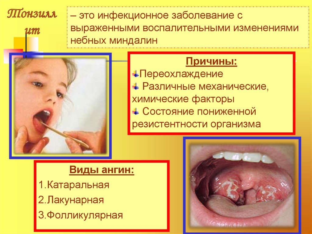 Грибковая ангина картинки