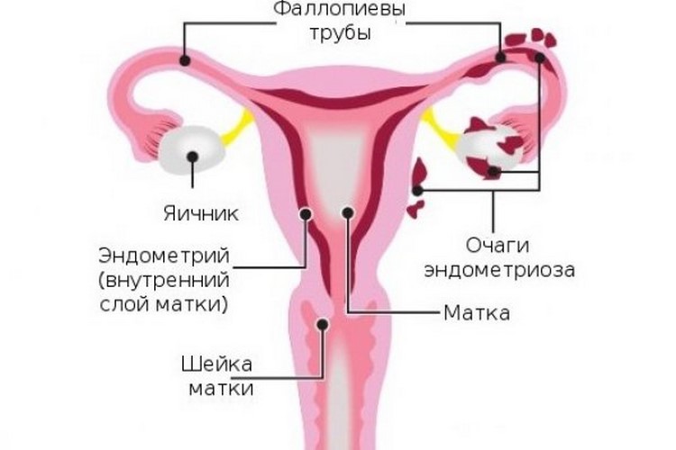 Ендометріоз і вагітність: як протікає захворювання на ранніх термінах, чи небезпечна хронічна форма шийки матки або яєчника перед пологами і як визначаються пологи, як вони протікають