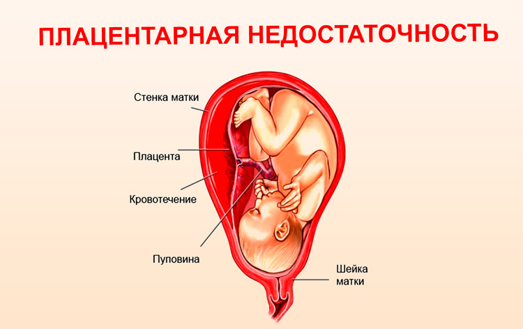Фетоплацентарна недостатність: ознаки і симптоми хронічної субкомпенсована або декомпенсованої плаценти 1, 2 ступеня і ризик ФПН для плоду і матері