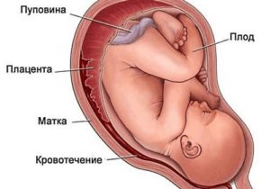 Гематома при вагітності на ранніх термінах: як виглядає заоболочечная на УЗД, чому зявляється, і як довго вона виходить, медикаментозне лікування гематоми ретрохориальной