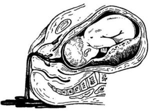 Гематома при вагітності на ранніх термінах: як виглядає заоболочечная на УЗД, чому зявляється, і як довго вона виходить, медикаментозне лікування гематоми ретрохориальной
