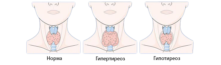 Гіпотиреоз під час вагітності або інші захворювання щитовидної залози: як вони впливають на плід, може на тлі гіпотиреозу бути порушення в роботі органів плоду, і що робити