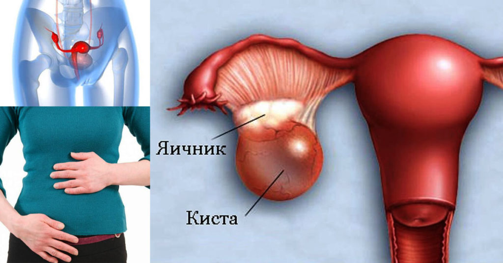 Кіста яєчників при вагітності: симптоми прояви у жінок фолікулярної, паровариальной або ендометріоїдних форми, способи лікування і небезпечні моменти для вагітної