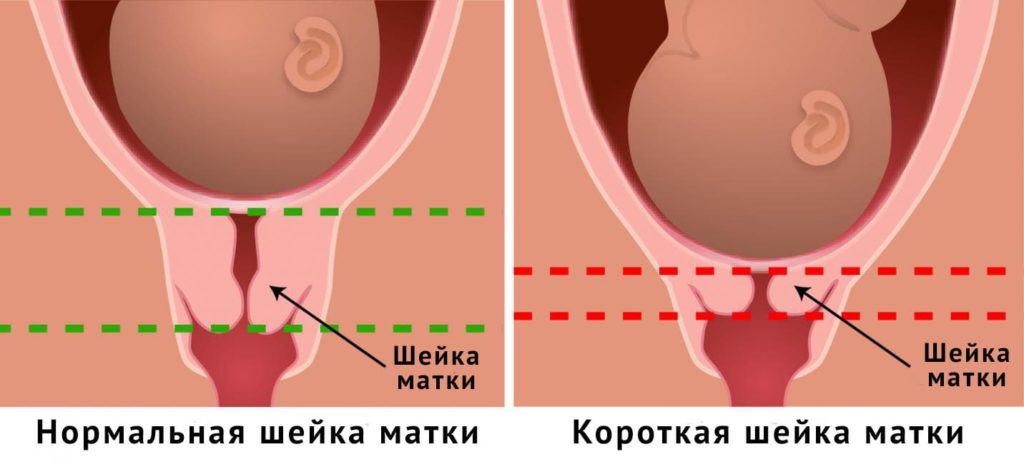 Коротка шийка матки при вагітності: причини укорочення у другому і третьому триместрі, чим загрожує коротка шийка на ранніх термінах і які методи лікування застосовуються