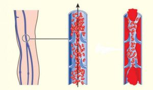 Порушення матково плацентарного кровотоку 1а ступеня, 2 або 3: наслідки для дитини гемодинаміки 1б ступеня, 1 а ступеня та ризики при 3 ступені, лікування і визначення пологів