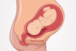 Відшарування плаценти при вагітності на ранніх або пізніх термінах: як проявляється крайове або часткове відшарування, лікується відшарування при аномальному розташуванні плоду