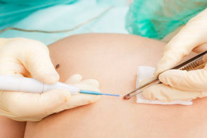 Папіломи при вагітності: як впливає вірус ВПЛ на плід, як відбувається лікування і що, якщо виявлені бородавки на статевих губах або близько ореол соска