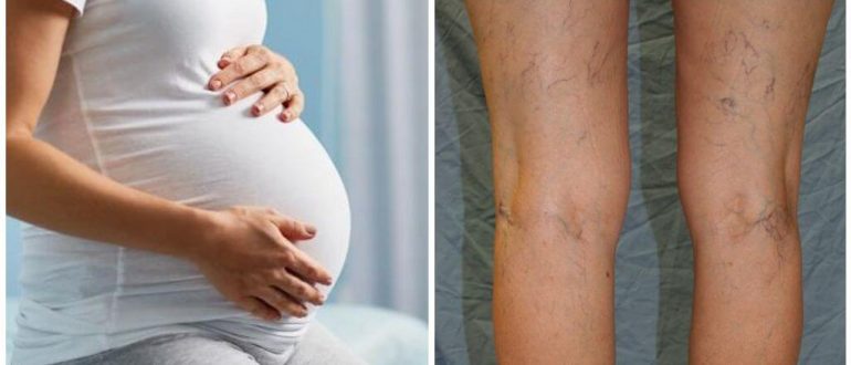 Варикоз під час вагітності та варіанти його лікування: чому зявляється варикозне розширення на ногах, руках, як його уникнути і запобігти, варто застосовувати компресійну білизну
