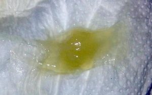 Зелені виділення при вагітності: зеленуваті без запаху, але густі в першому триместрі, з кислим запахом у другому і зеленувато жовті в третьому триместрі перед пологами